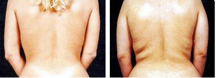 Ultralyd liposuction pris